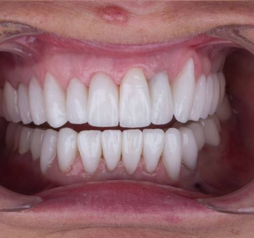 Dental Clinic Turkey Before After Picture Case 1 (Emax Veneers)