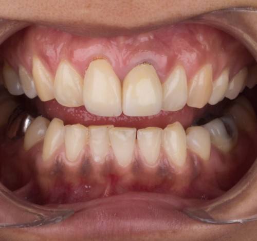 Dental Clinic Turkey Before After Picture Case 6 (Emax Veneers)