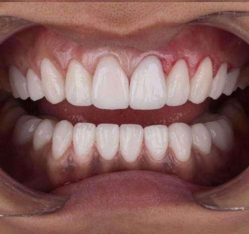 Dental Clinic Turkey Before After Picture Case 6 (Emax Veneers)