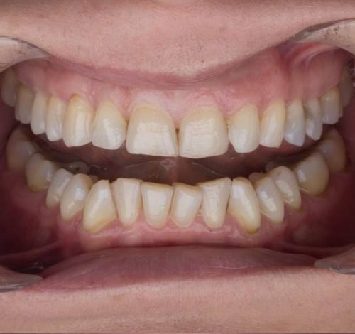 Dental Clinic Turkey Before After Picture Case 7 (Emax Veneers)
