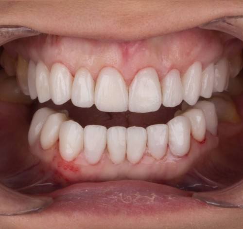 Dental Clinic Turkey Before After Picture Case 8 (Emax Veneer)