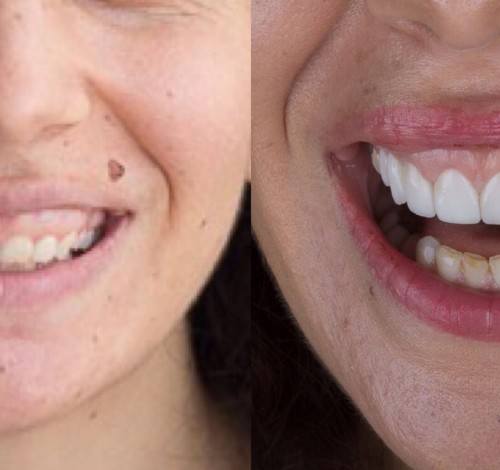 Dental Clinic Turkey Before After Picture Case 9 (Emax Veneer)
