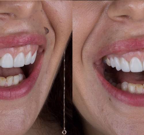 Dental Clinic Turkey Before After Picture Case 9 (Emax Veneer)