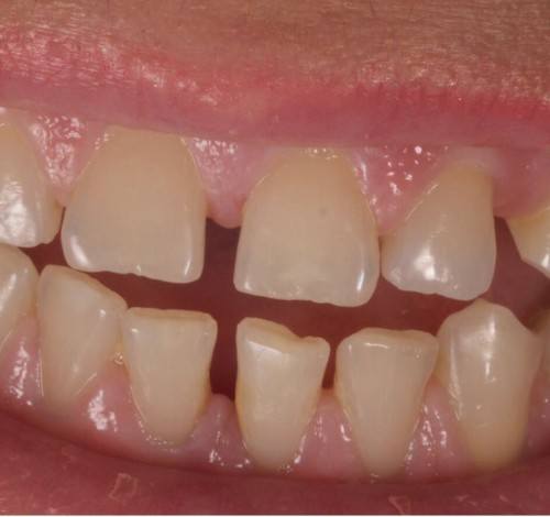 Dental Clinic Turkey Before After Picture Case 10 (Emax Veneer)