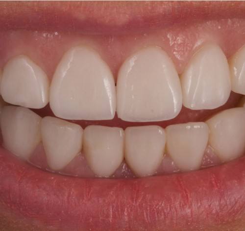 Dental Clinic Turkey Before After Picture Case 10 (Emax Veneer)