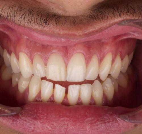 Dental Clinic Turkey Before After Picture Case 2 (Emax Veneers)