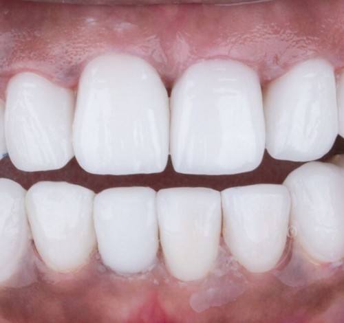 Dental Clinic Turkey Before After Picture Case 11 (Emax Full Porcelain Crowns)