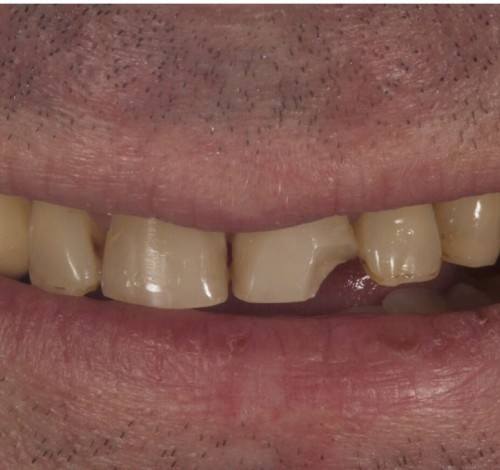Dental Clinic Turkey Before After Picture Case 12 (Emax Porcelain Crowns)