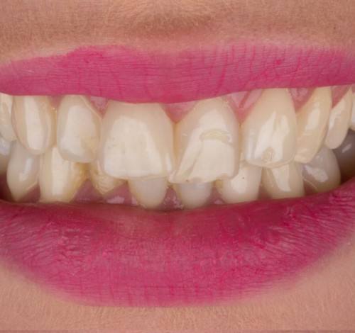 Dental Clinic Turkey Before After Picture Case 13 (Emax Full Porcelain Crowns)