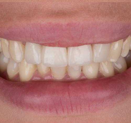 Dental Clinic Turkey Before After Picture Case 13 (Emax Full Porcelain Crowns)