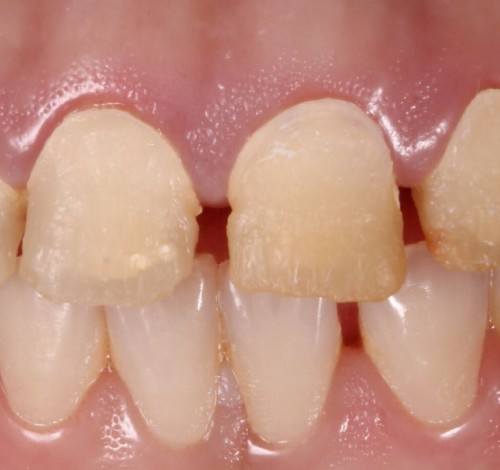 Dental Clinic Turkey Before After Picture Case 14 (Emax Porcelain Crowns)
