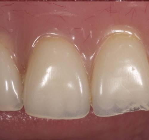 Dental Clinic Turkey Before After Picture Case 15 (Implant Supported Metal Based Porcelain Bridge)