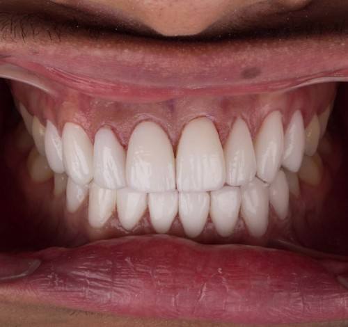 Dental Clinic Turkey Before After Picture Case 2 (Emax Veneers)