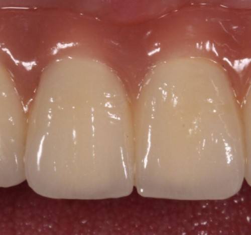 Dental Clinic Turkey Before After Picture Case 15 (Implant Supported Metal Based Porcelain Bridge)