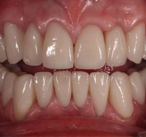 Dental Clinic Turkey Before After Picture Case 16 (Zirconium Crown)