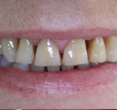 Dental Clinic Turkey Before After Picture Case 16 (Zirconium Crown)
