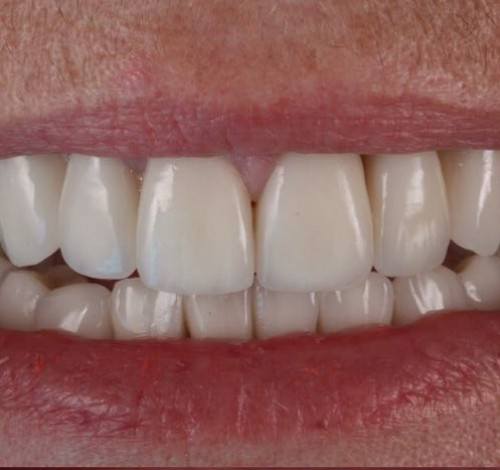 Dental Clinic Turkey Before After Picture Case 16 (Zirconium Crown)