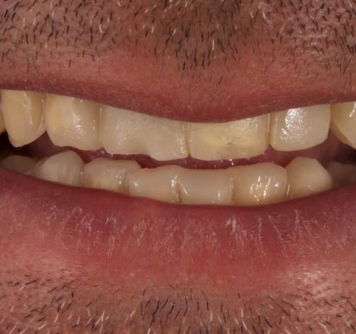 Dental Clinic Turkey Before After Picture Case 17 (Emax Veneers)