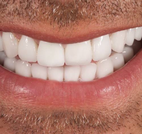 Dental Clinic Turkey Before After Picture Case 17 (Emax Veneers)