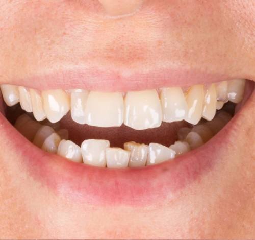 Dental Clinic Turkey Before After Picture Case 3 (Emax Veneers)