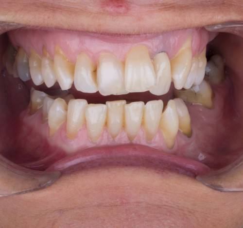Dental Clinic Turkey Before After Picture Case 1 (Emax Veneers)