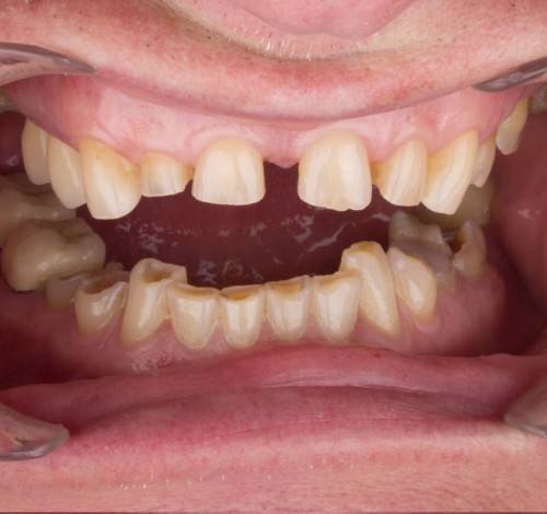 Dental Clinic Turkey Before After Picture Case 4 (Zirconium Crowns)