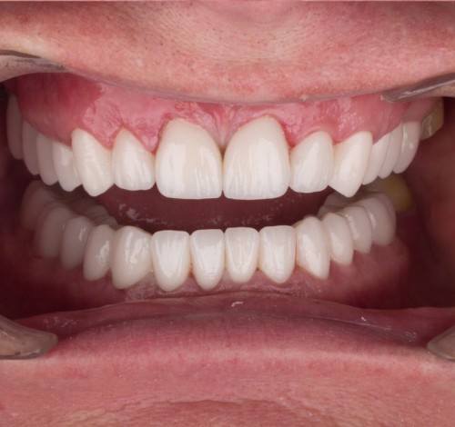 Dental Clinic Turkey Before After Picture Case 4 (Zirconium Crowns)