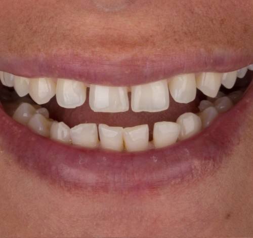 Dental Clinic Turkey Before After Picture Case 5 (Composite Veneers)