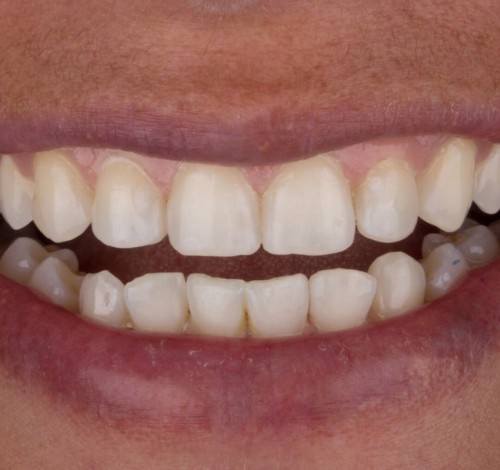 Dental Clinic Turkey Before After Picture Case 5 (Composite Veneers)